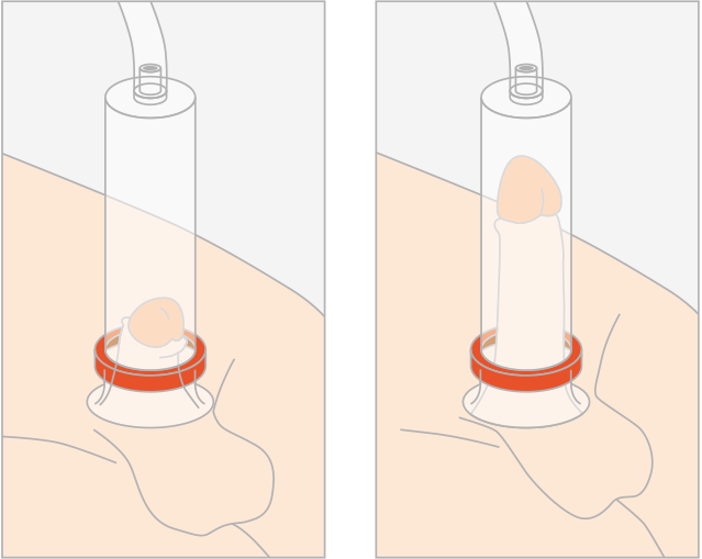 Vacuum Device - Lorraine Grover